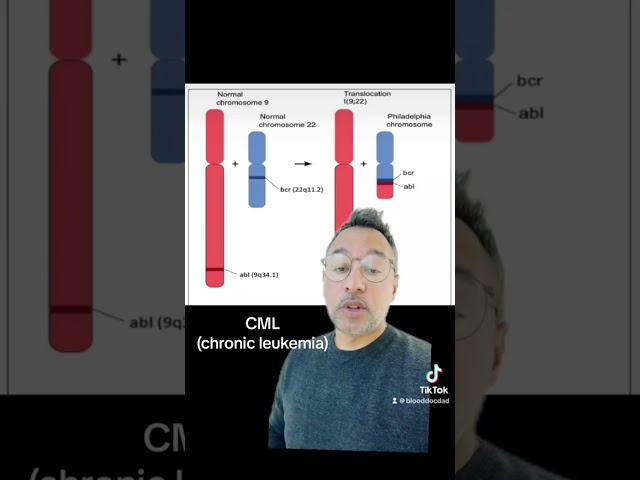 Chronic myeloid leukemia #medicine #leukemia #hematology #blood #cml #fyp #trending