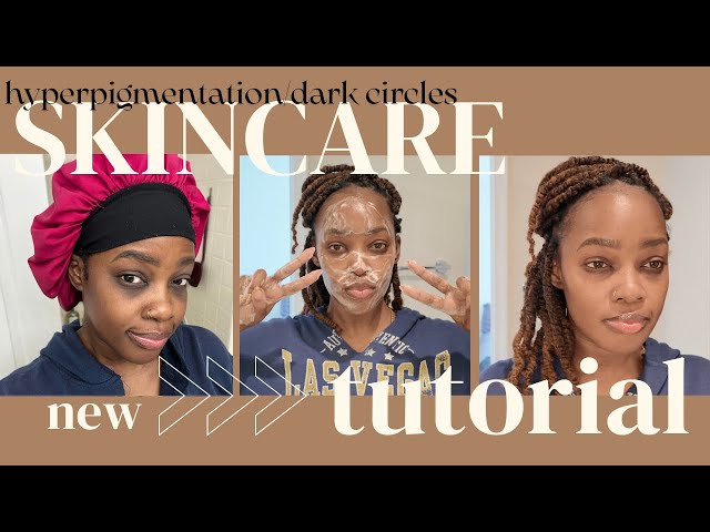 4-WEEK SKIN FLIP! The ONLY Thing That Fixed My Dark Circles + HYPERPIGMENT 😳 YOU WON'T BELIEVE IT ✨