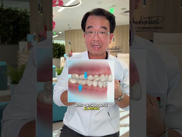 Invisalign can fix your overbite! #orthodontist #braces #invisalign #teeth #orthotips #overbite