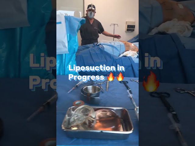Liposuction in progress By Dr.Bucio #plasticsurgery #lipo #liposuction #sandiego #tijuana #lipo360