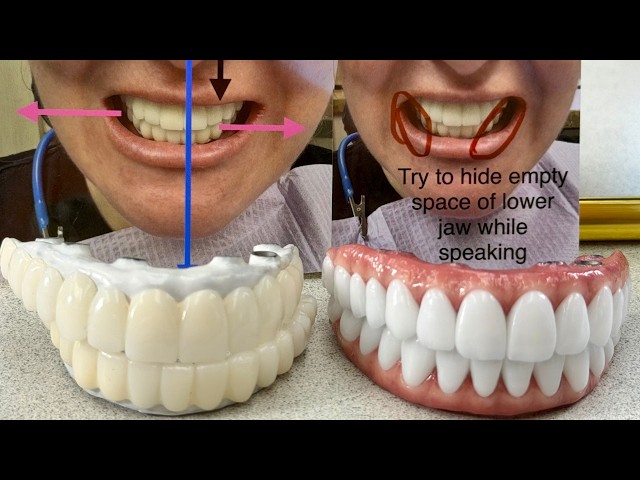 Thin Ceramic full-Mouth Implants Bridge Perfectly Executed