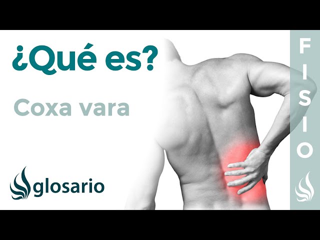 COXA VARA | Qué es, qué afecta, síntomas, signos clínicos, causas y tratamiento fisioterapéutico