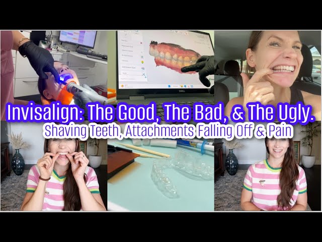 Invisalign Journey: The Good, The Bad, The UGLYShaving Teeth, Attachments Falling Off & Pain