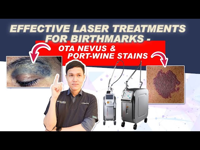 ⁠ ⁠PicoPlus & Derma-V Laser for Birthmark Removal | Ota Nevus & Port-Wine Stains