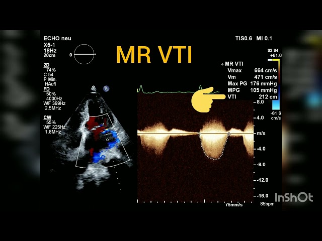 How to quantify Mitral regurgitation with PISA method?