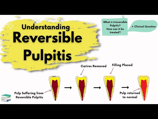 Reversible Pulpitis | Causes, Diagnosis and Treatment |  Endodontics