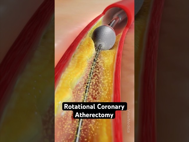Grinding plaque from coronary arteries (3D Animation)