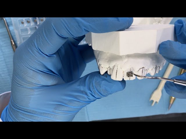 Cementing brackets in orthodontics. Necessary materials and steps for proper placement.