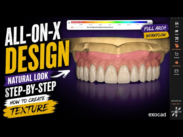 ALL ON X design in EXOCAD step by step