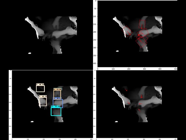 Hand Detection and Determination of their Orientation in Depth Images in the Field of Surgery (out)