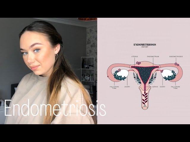 My Endometriosis Journey | Interstitial cystitis | Menopause | Infertility | Zoladex