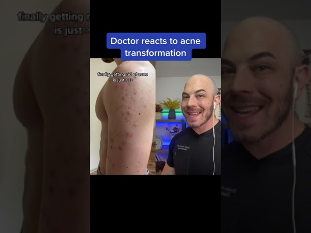 Doctor reacts to crazy acne transformation! #acne #dermreacts #accutane