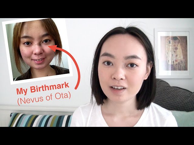 I Had a Birthmark on My Face - 4 Years After Removal (Nevus of Ota)