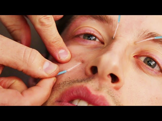 The Try Guys Try Acupuncture