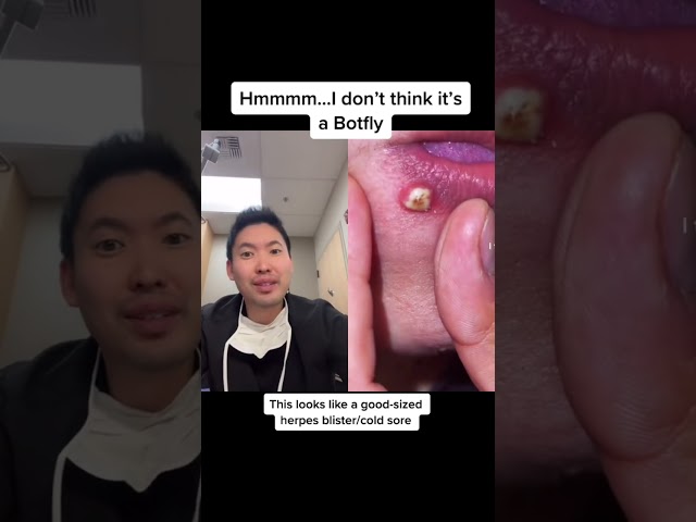 #shorts Pimple or Botfly or Cold Sore???