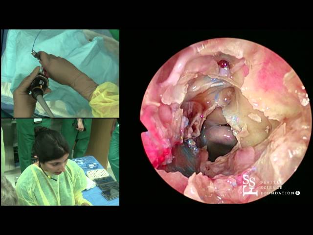 Frontal & Sphenoid Sinuses Demonstration by Zara Patel, MD