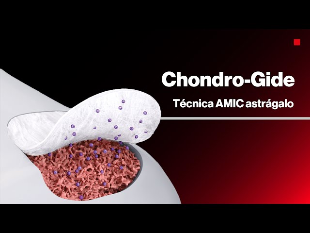 AMIC CHONDRO-GIDE® | Reparación de cartílago en el astrágalo