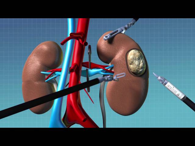 Treating Kidney Cancer