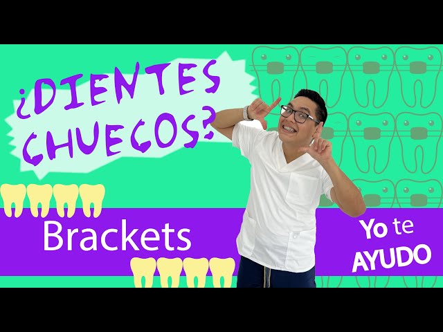 This is HOW METALLIC BRACKETS ARE PUT ON - Step-by-Step Bracket Installation (Video in 🔴 LIVE)🤗