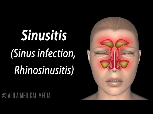 Sinusitis, Animation.